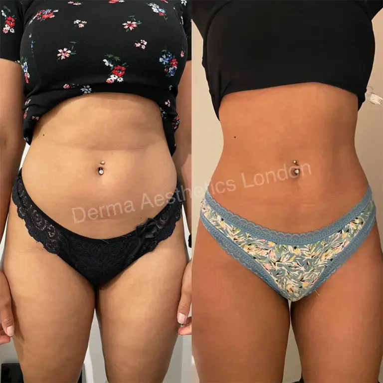 fat disoloving treatments