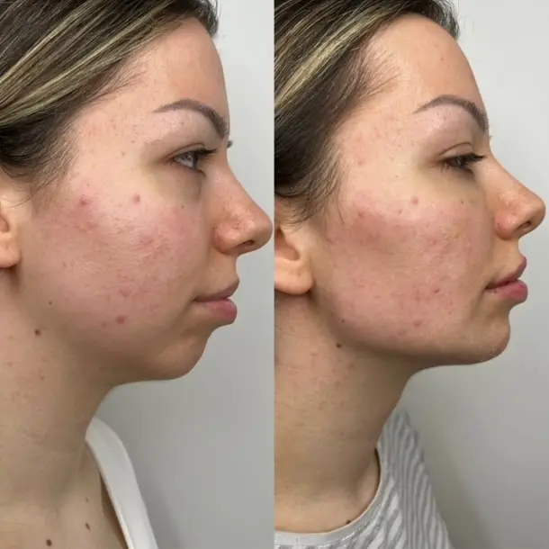jawline enhancement treatment