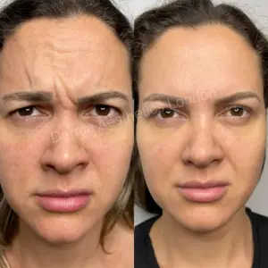 anti wrinkle treatments
