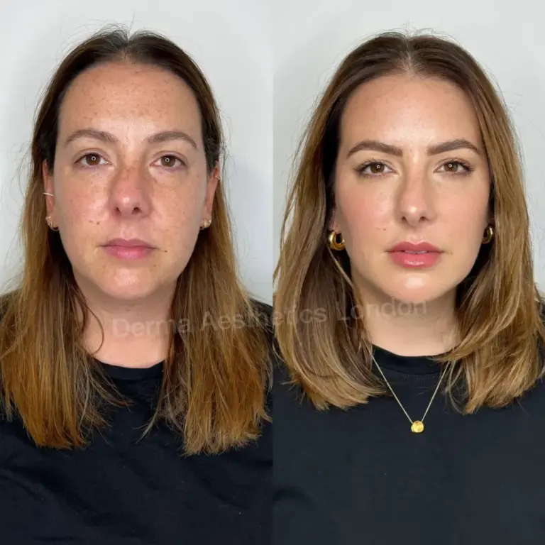 before and after facial harmonisation