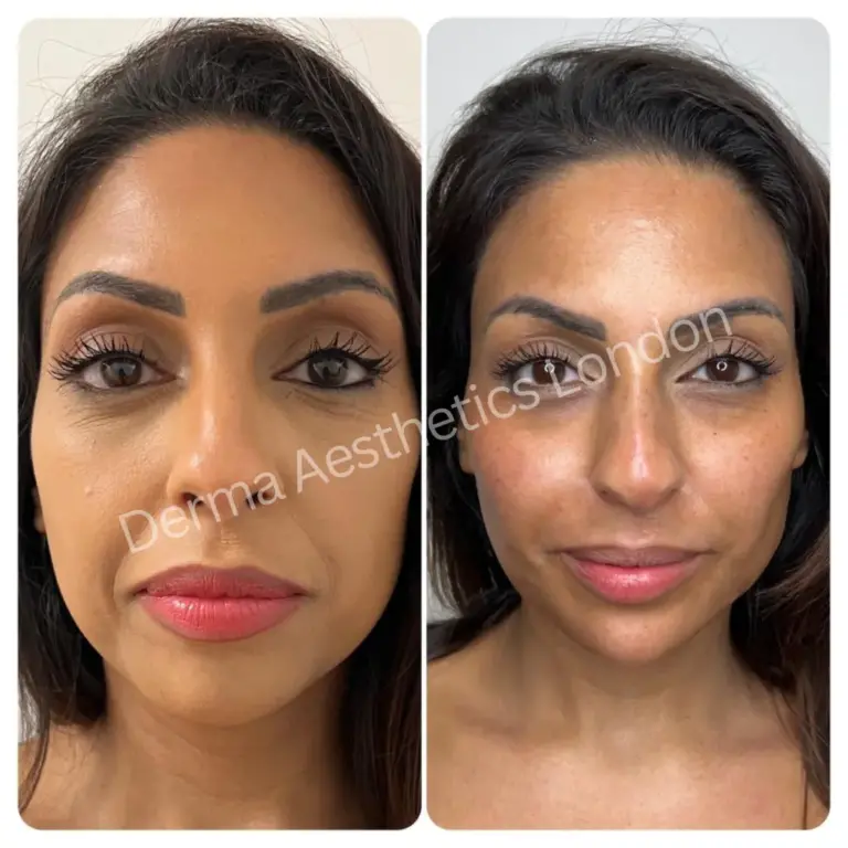 before and after facial rejuvenation 1