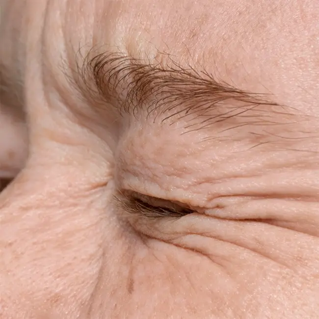 crows feet treatment