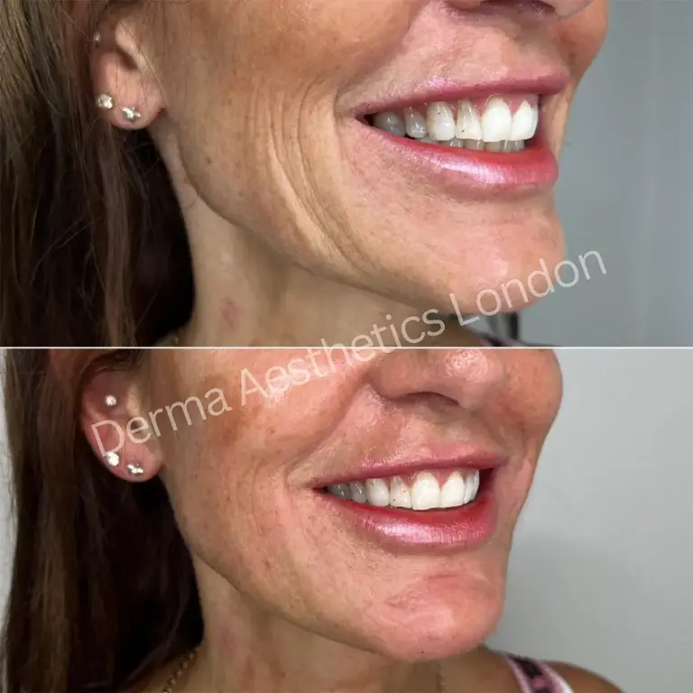 laugh lines treatment