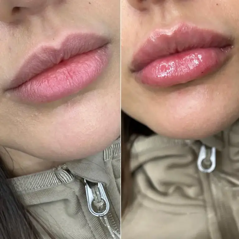 lip fillers