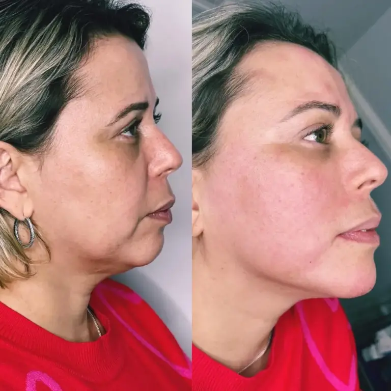 marionette lines treatment