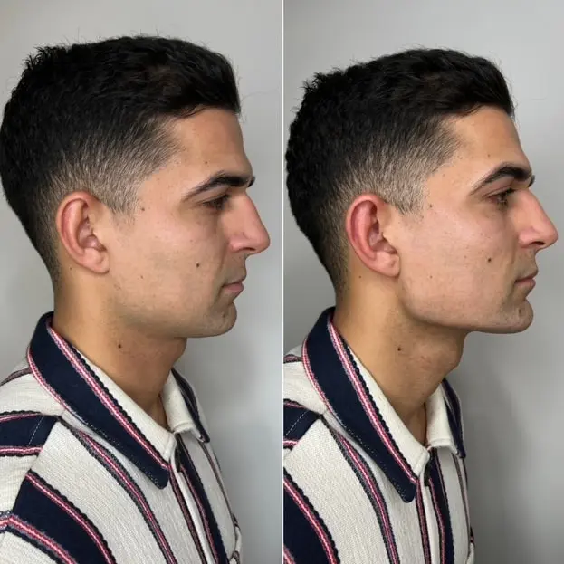 masculinisation treatment