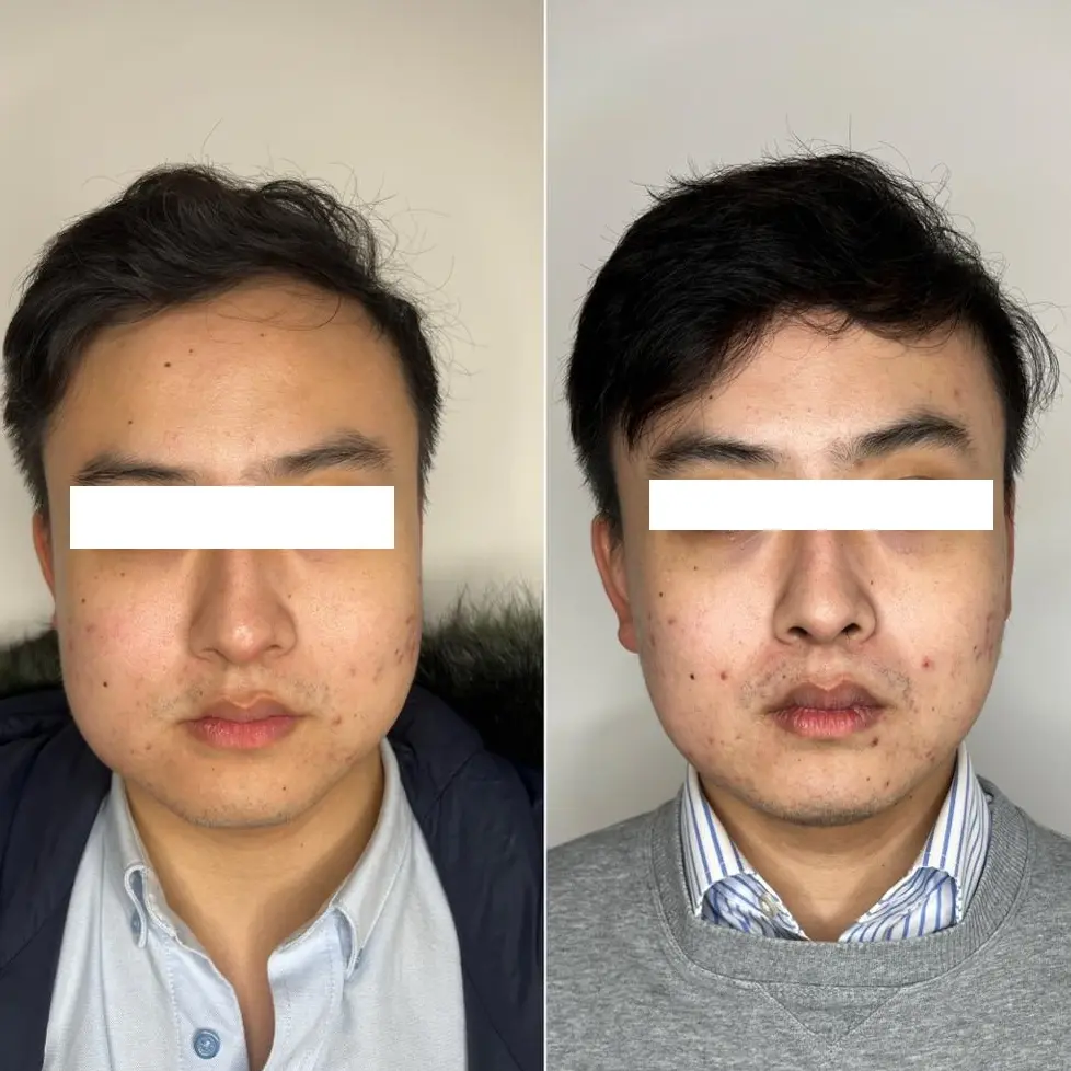 Face Slimming Malaysia