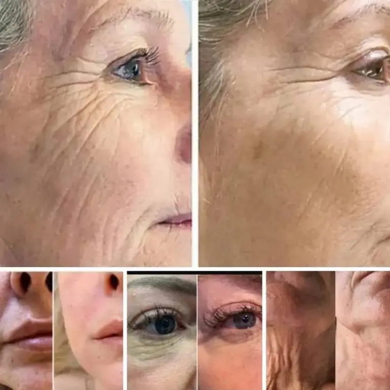 sunekos and jalupro skin boosters