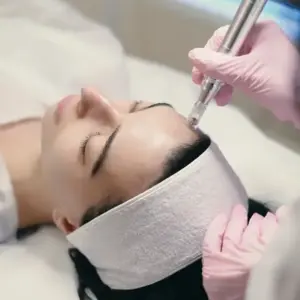 vivace radio frequency with microneedling