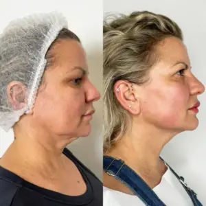 Endolift Marylebone
