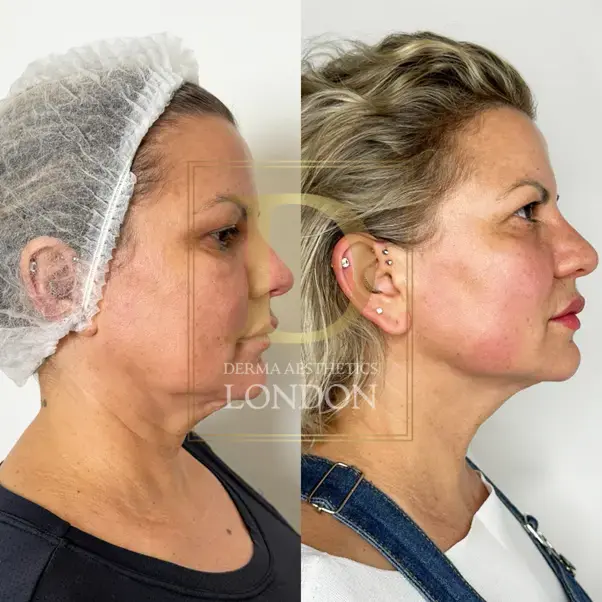 endolift before after london watermark 01