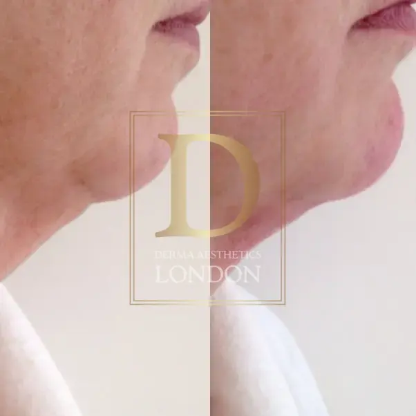 endolift before after london watermark 02