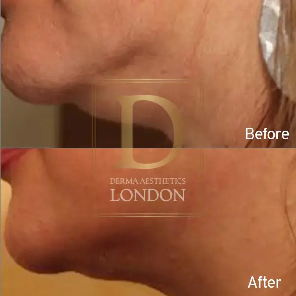 endolift before after london watermark 03