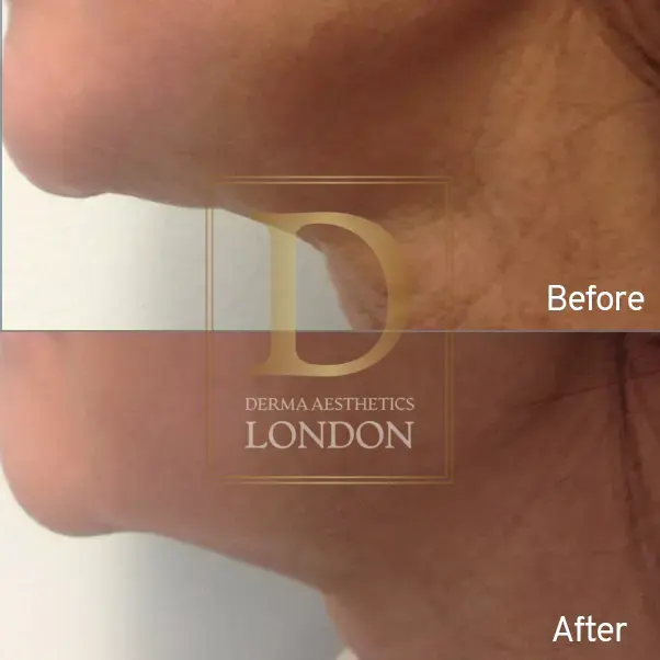 endolift before after london watermark 04