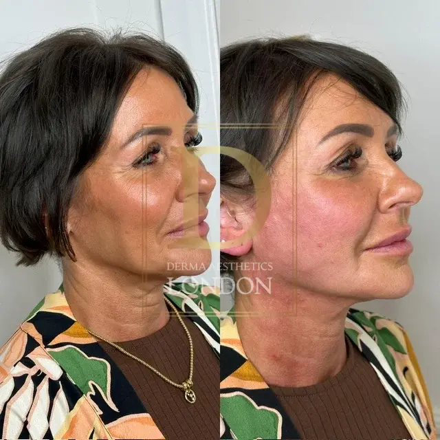 endolift before after london watermark 05