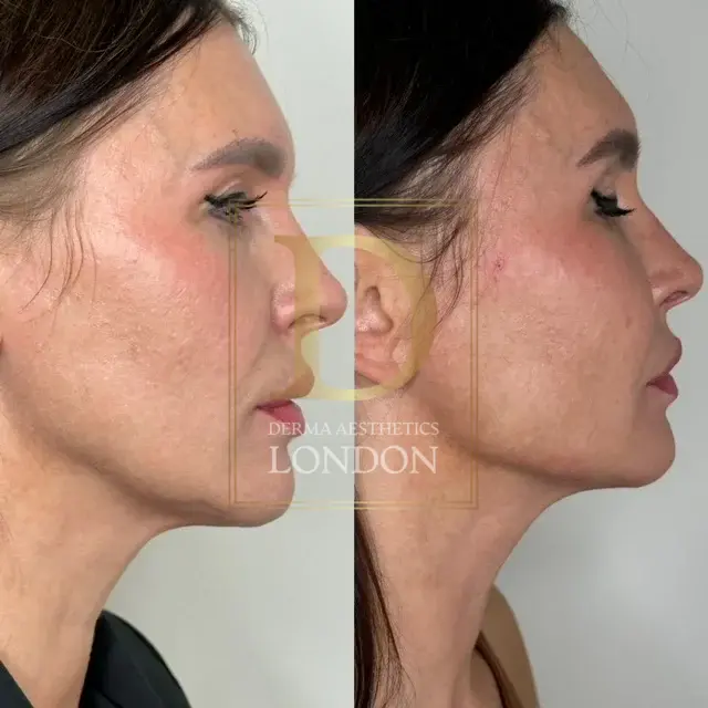 endolift before after london watermark 06