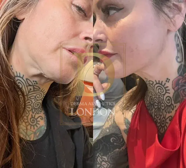 endolift before after london watermark 07