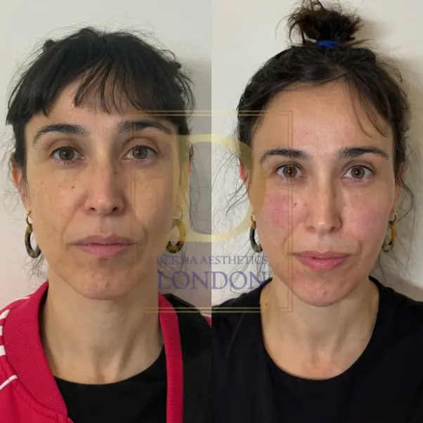 BioFiller before and after 1