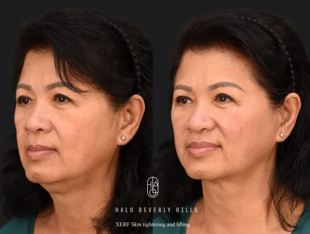 Before and After 10