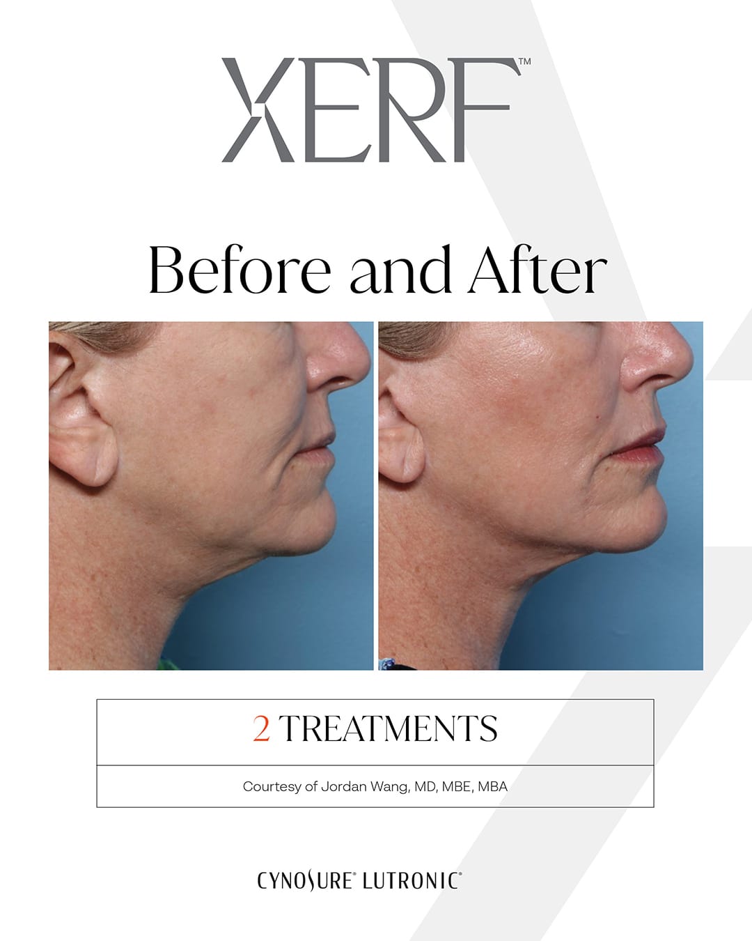 XERF B&A 1 (1)