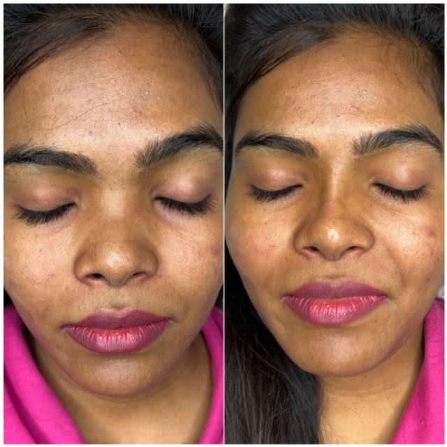 Before and After Liquid Rhinoplasty