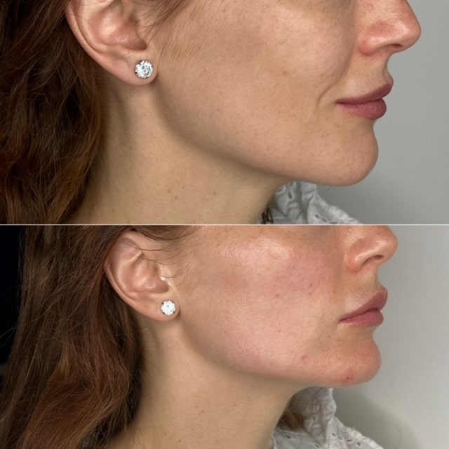 Before and After Jawline Filler 8
