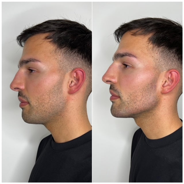 Before and After Jawline Filler 9