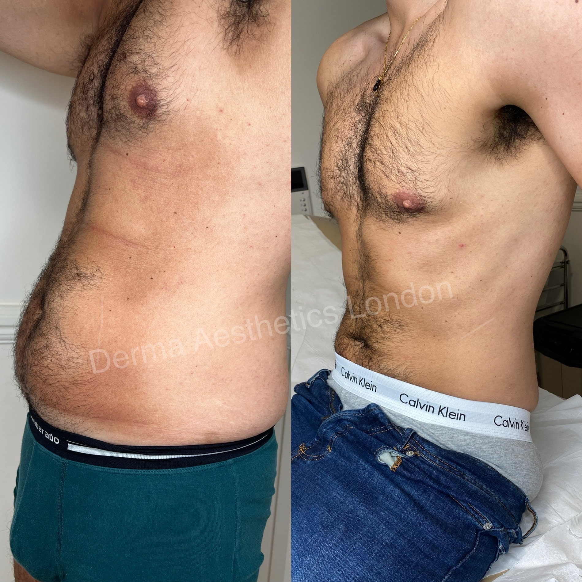 Before and After Cryolipolysis 3