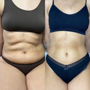 Before and After Cryolipolysis