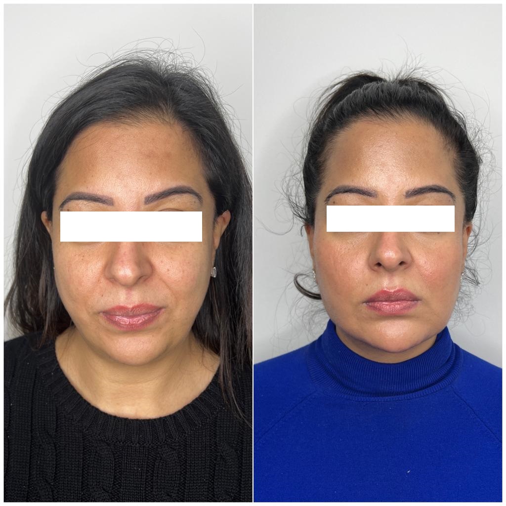 https://dermaaestheticslondon.com/wp-content/uploads/2023/03/before-and-after-facial-slimming.jpeg