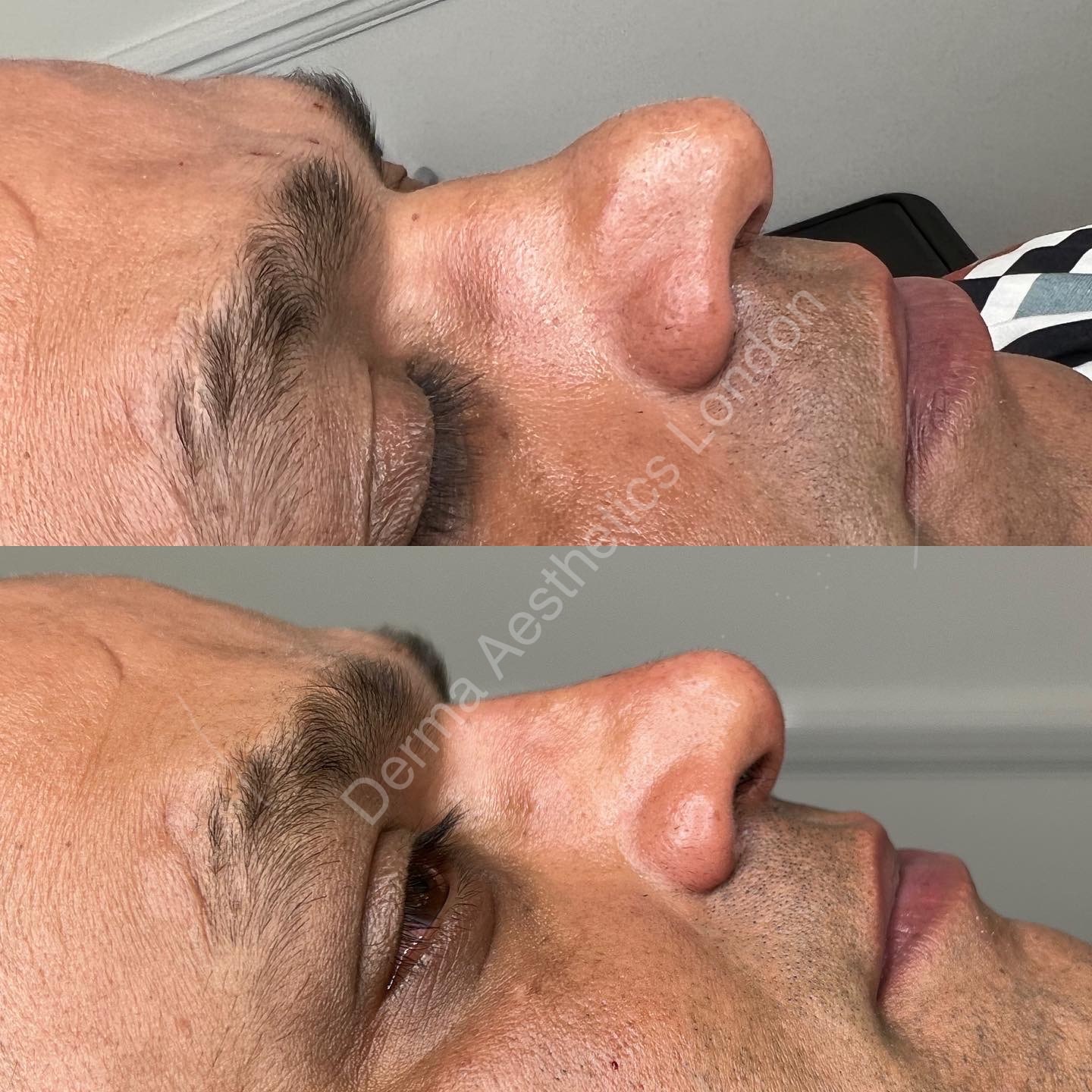 Before and After Liquid Nose Job