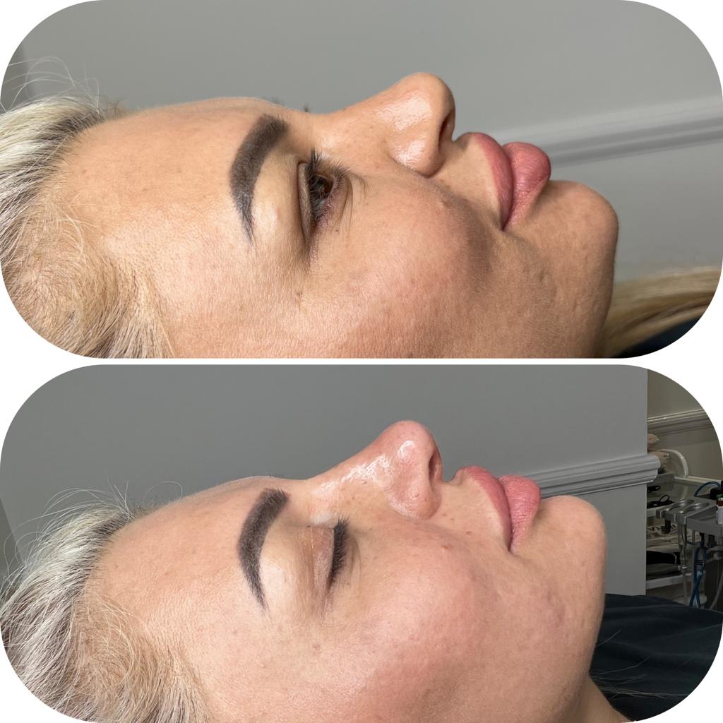 Before and After Nose Filler