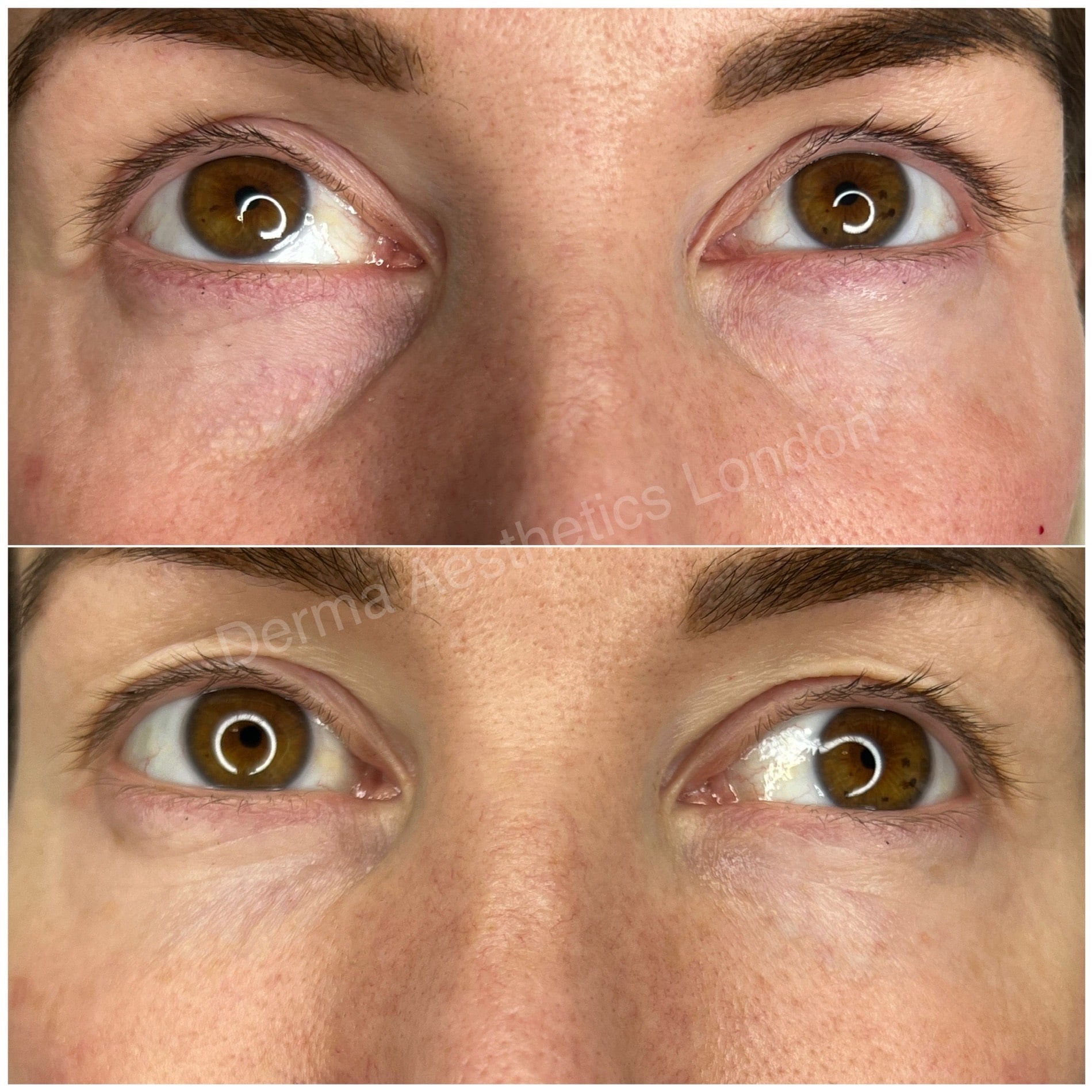 Before and After Tear Trough Filler 7