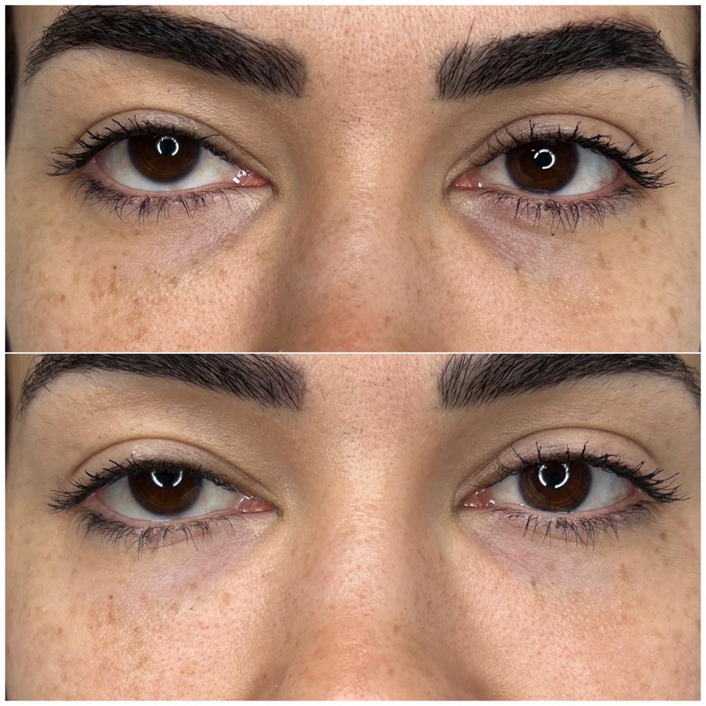 Before and After Light Eyes Treatment 2