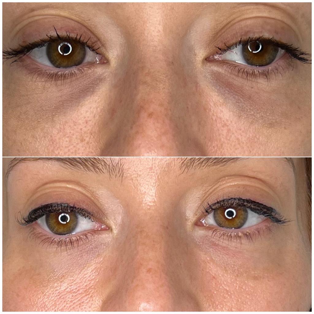 Before and After Light Eyes Treatment