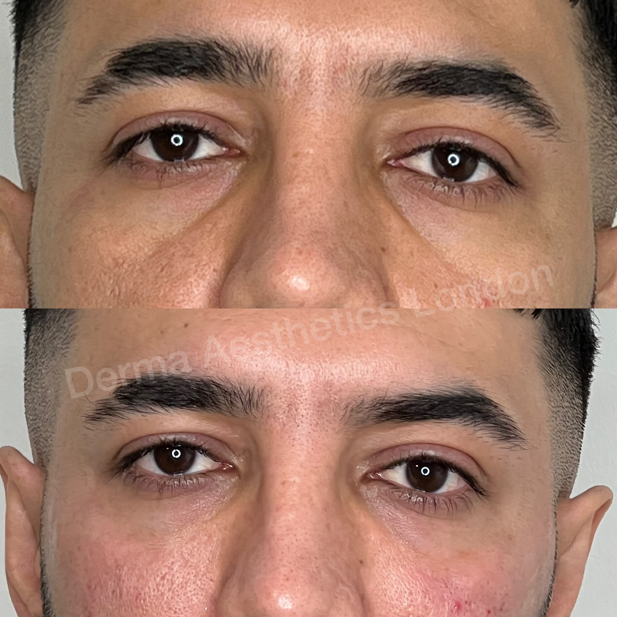 Before and After Tear Trough Filler