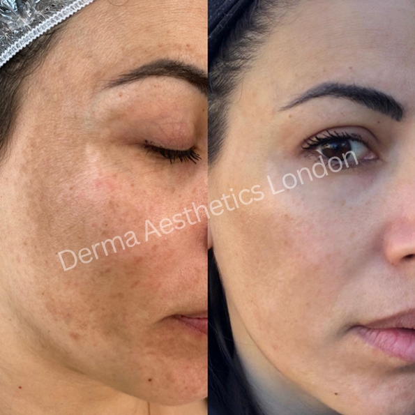 Before and After Chemical Peels 2
