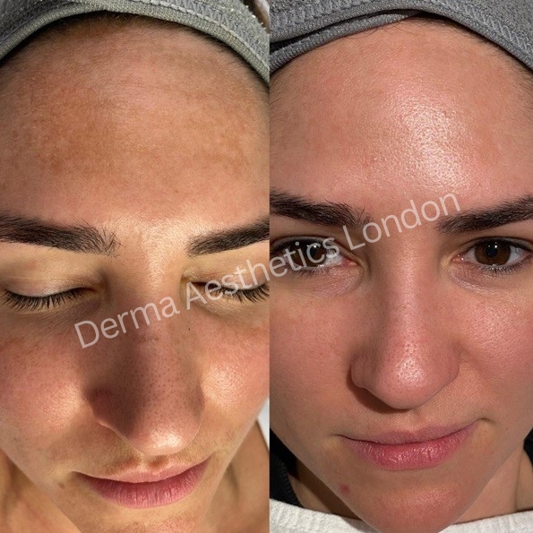 Before and After Chemical Peels 3