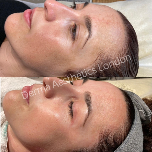 Before and After Chemical Peels 4