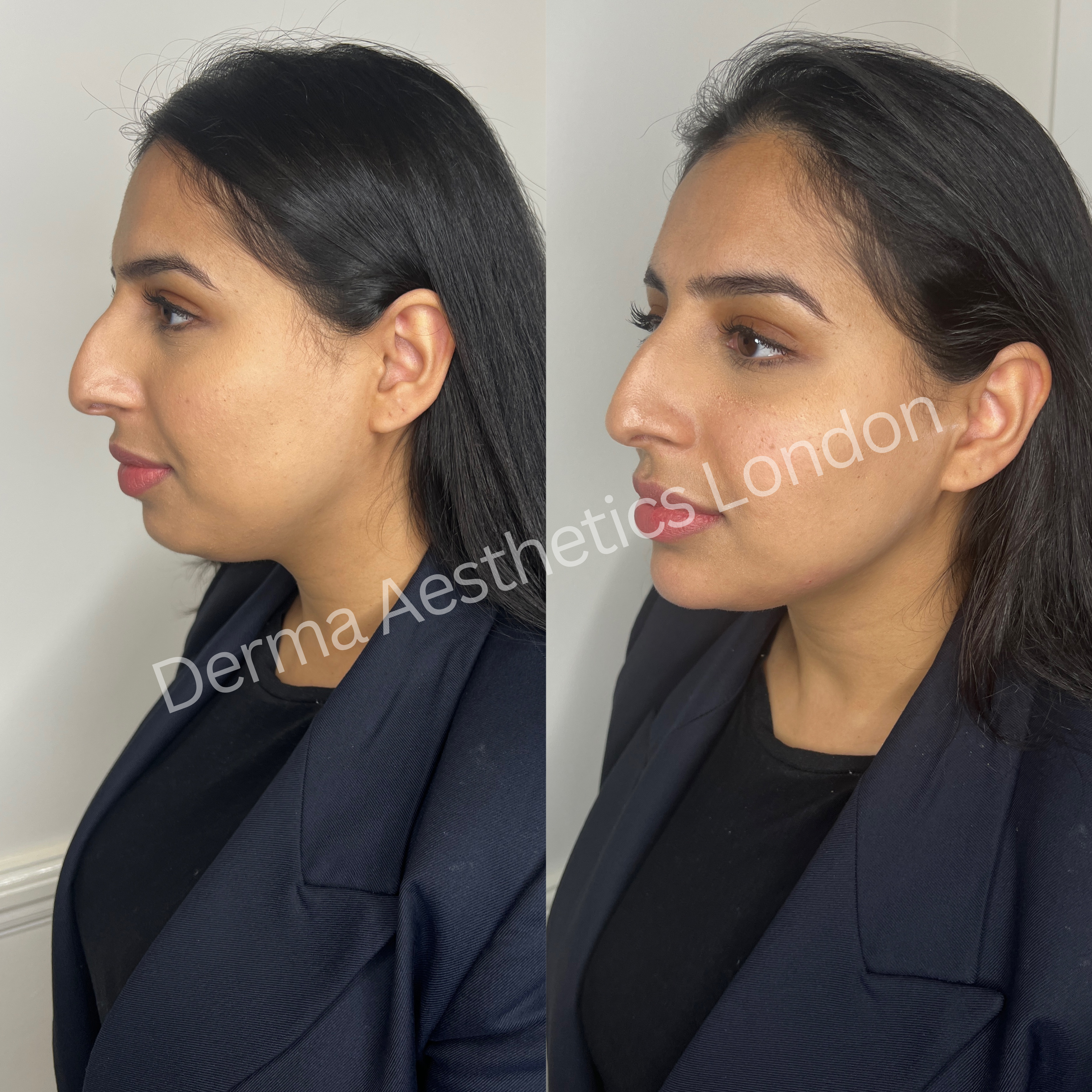 Before and After Chin Filler 3