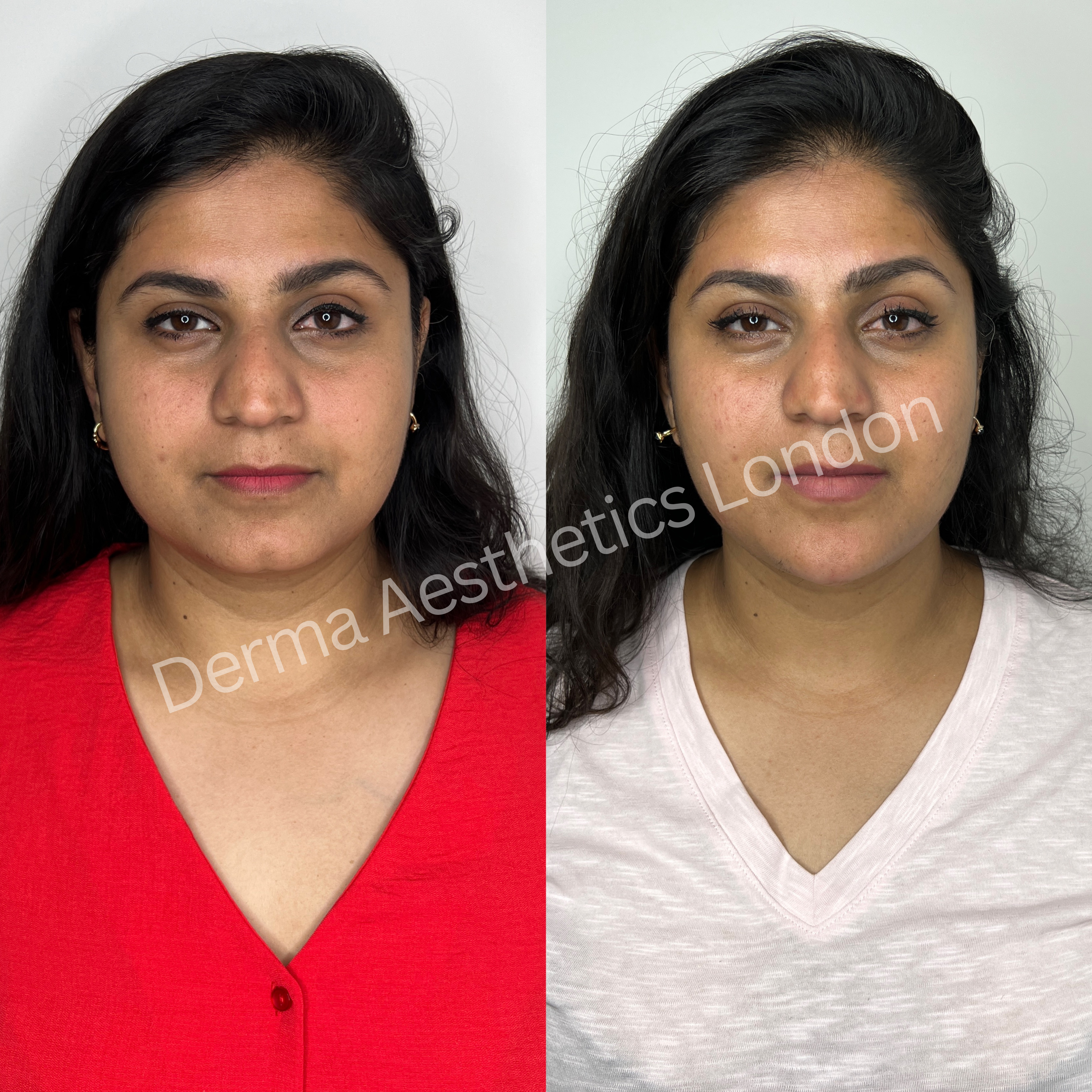 Before and After Chin Filler 4