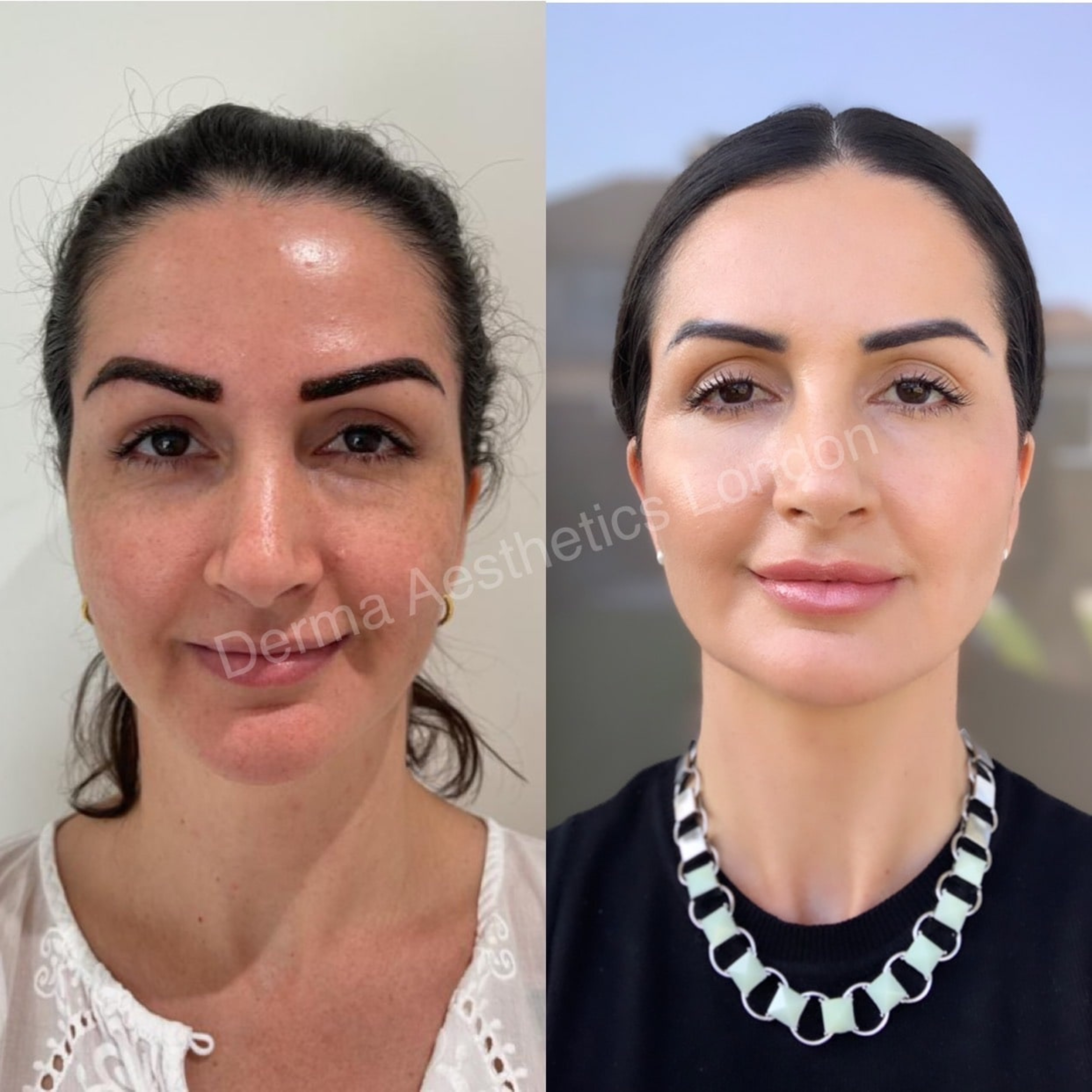 Before and After Facial Harmonisation 3