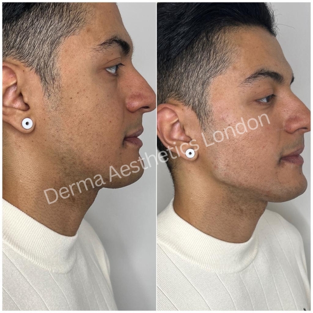 Before and After Jawline Filler 10