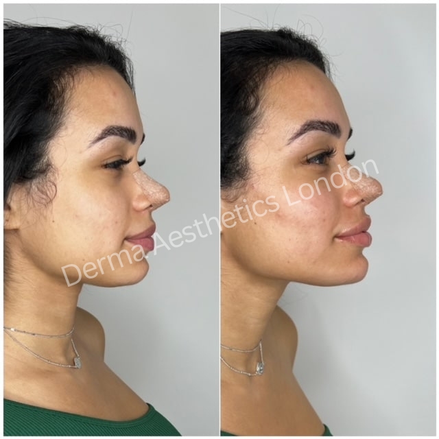 Before and After Jawline Filler 4