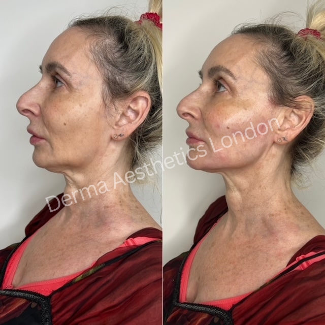 Before and After Jawline Filler 6