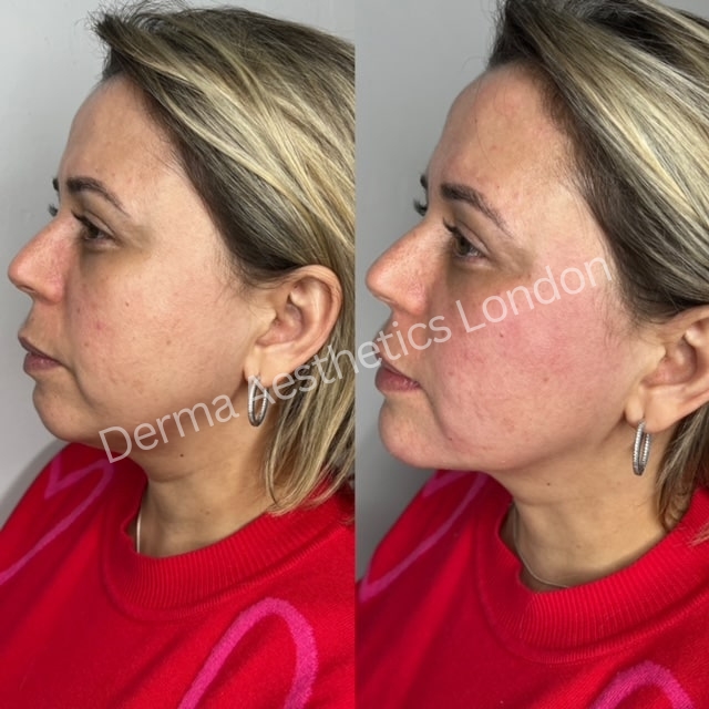 Before and After Jawline Filler 7