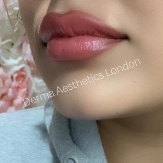 Lip Fillers Results