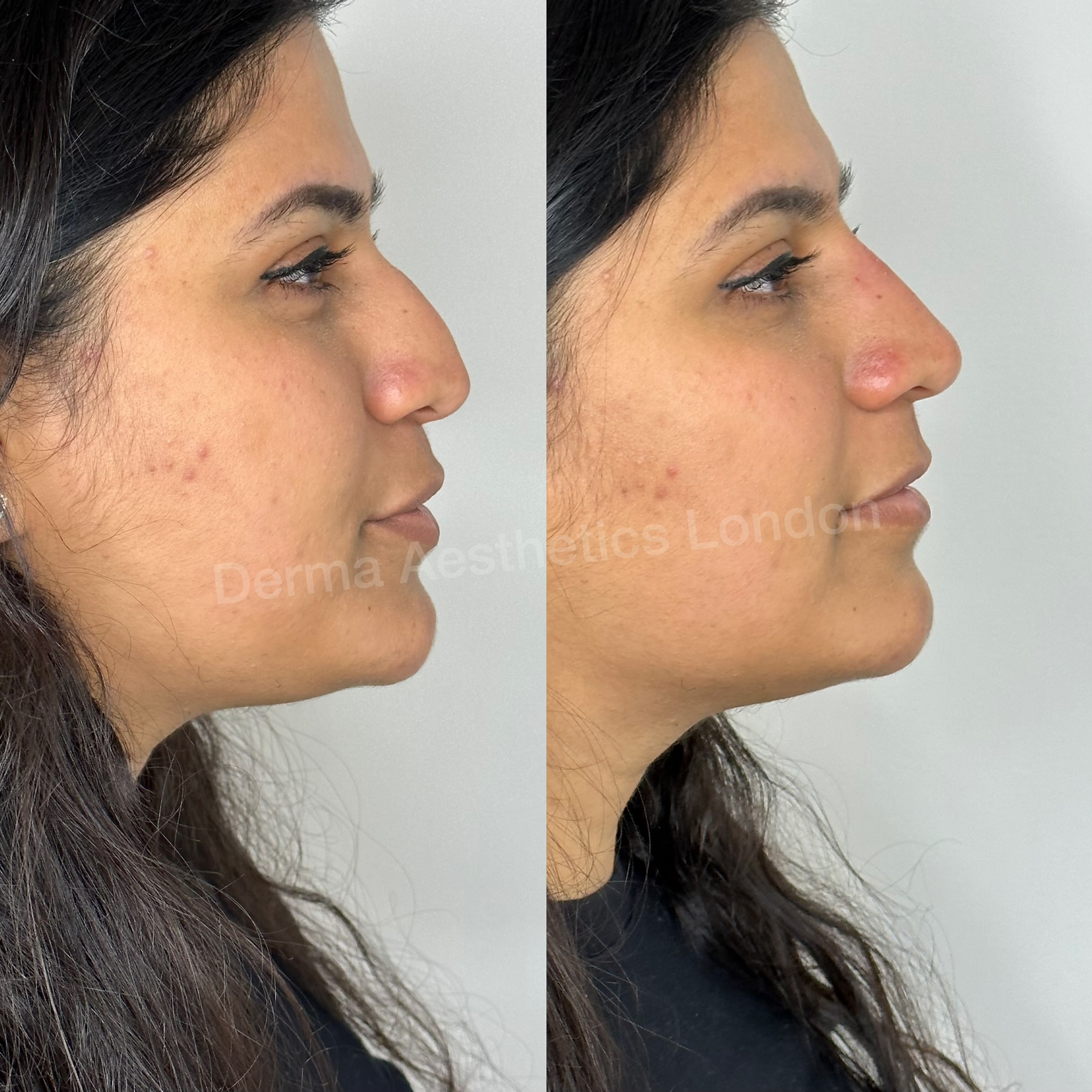 Before and After Non-Surgical Rhinoplasty