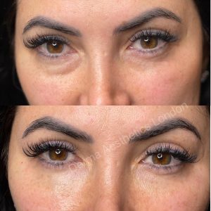 Before and After Eye Bag Filler