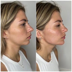 Before and After Jawline Filler 5